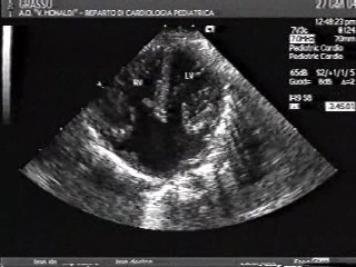 Ảnh siêu âm mỏm bốn buồng của kênh nhĩ thất toàn phần